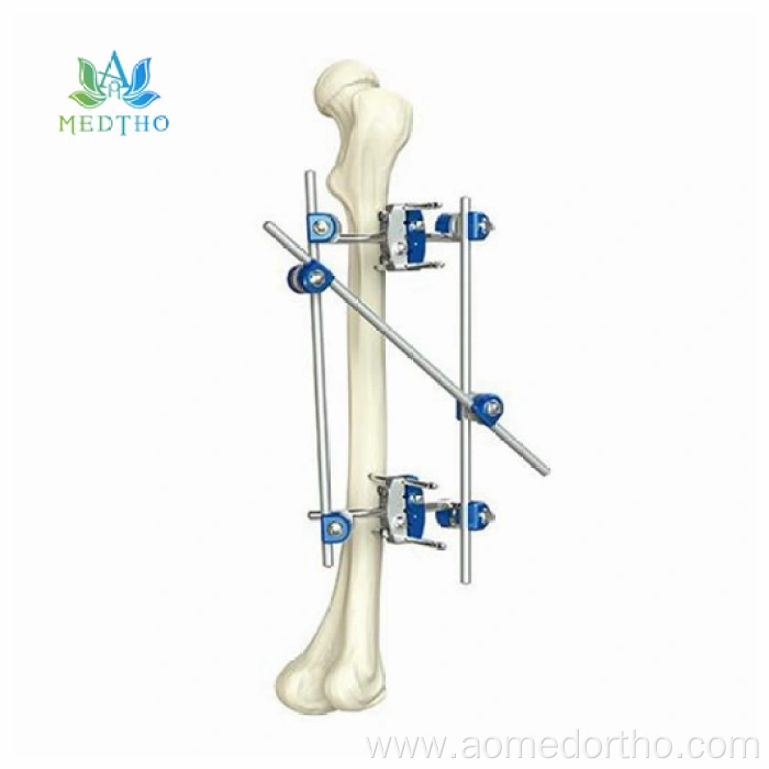 ex fix tibia
